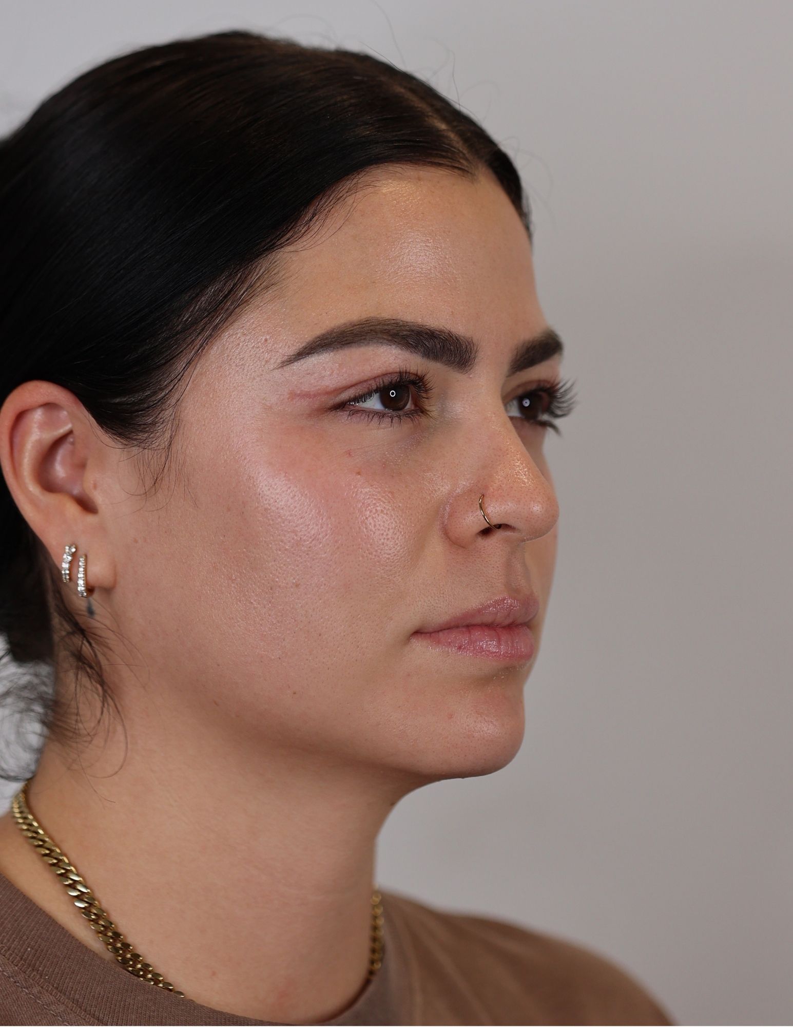Upper Eyelid Lift (Upper Blepharoplasty)