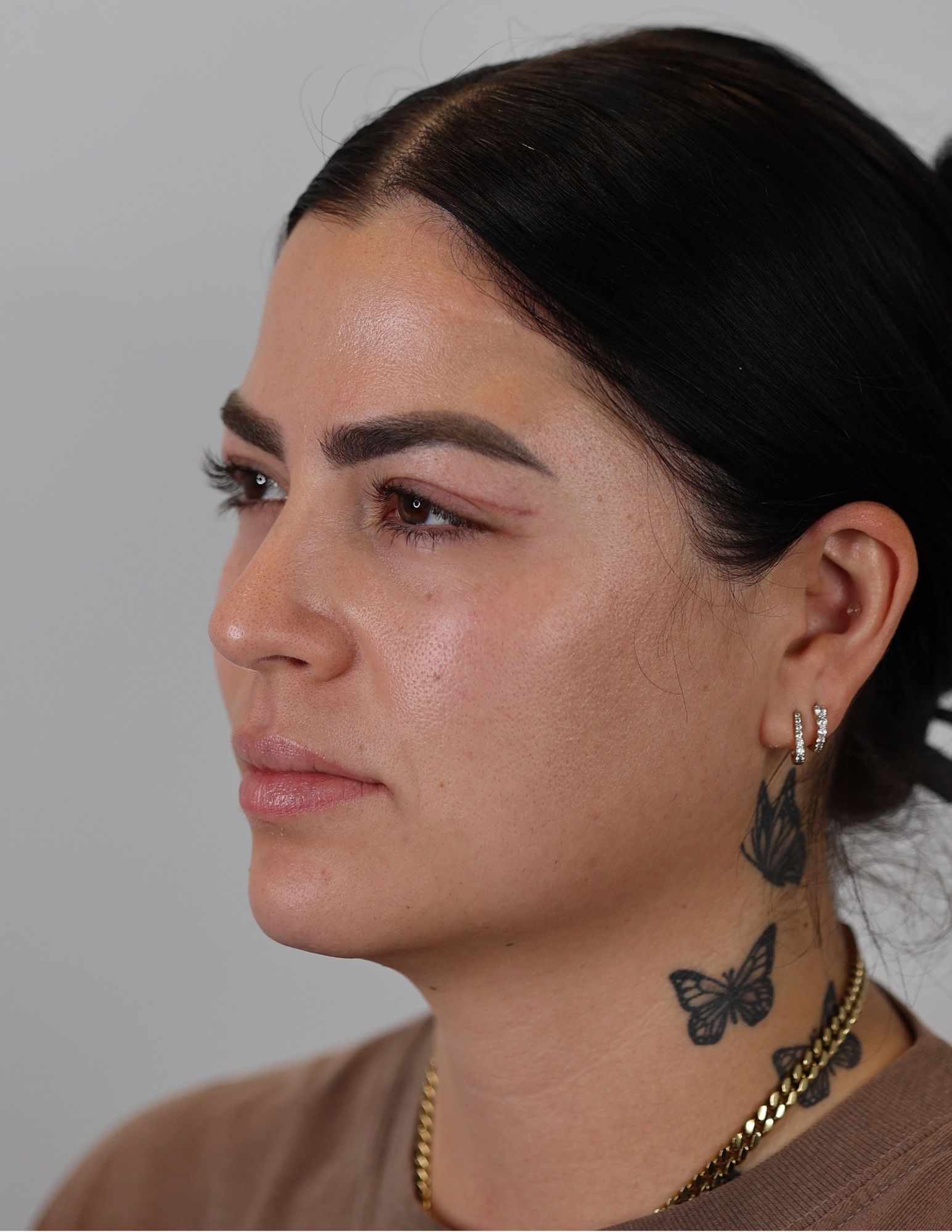 Upper Eyelid Lift (Upper Blepharoplasty)