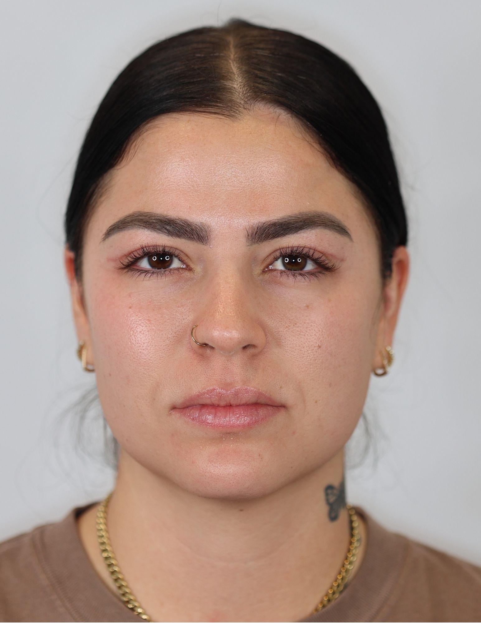 Upper Eyelid Lift (Upper Blepharoplasty)