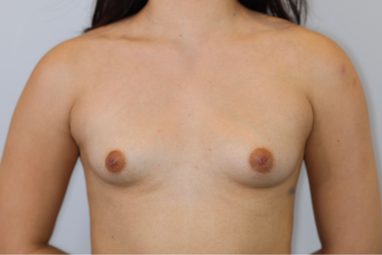 Breast Augmentation