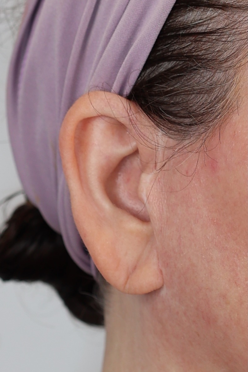Earlobe Reduction