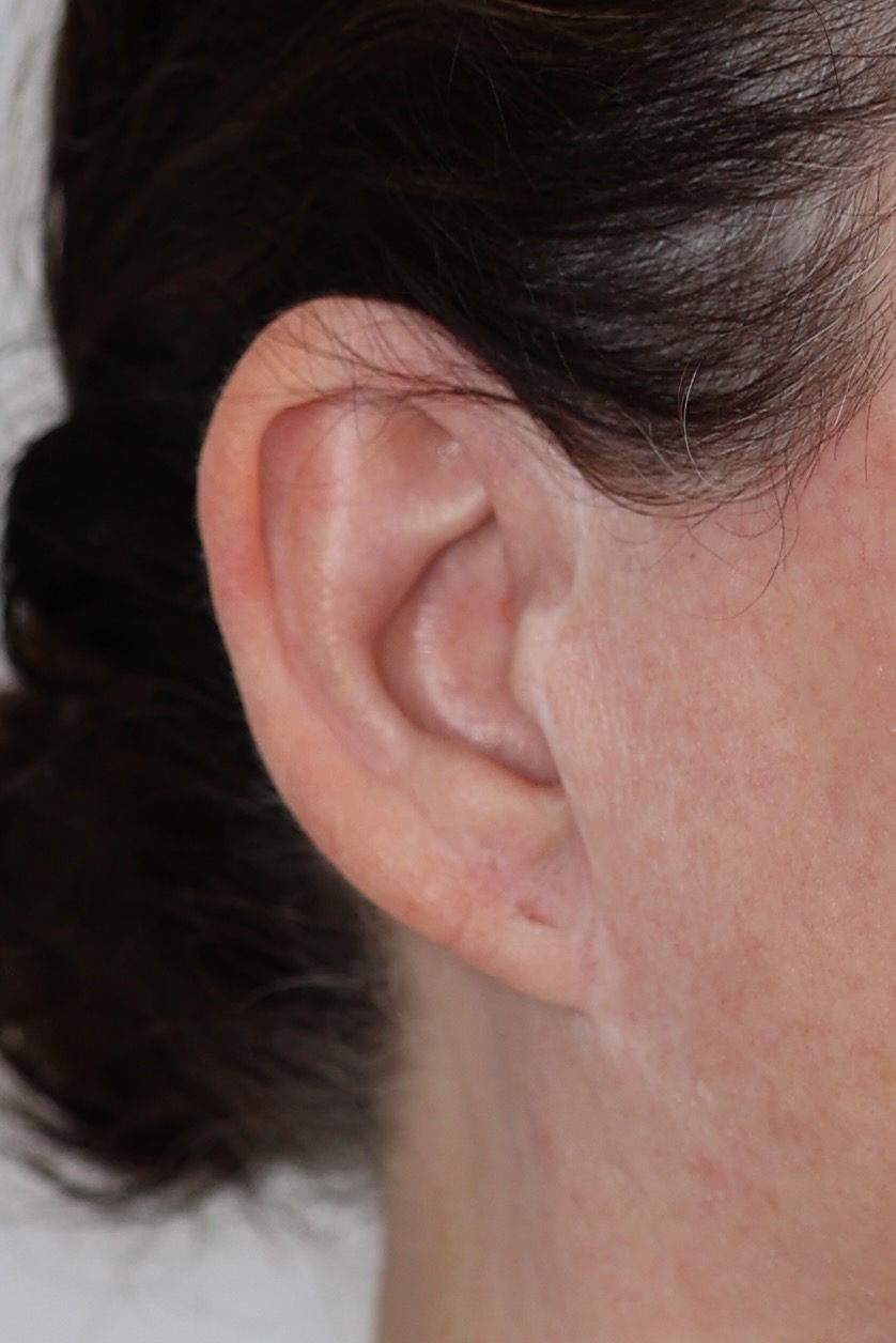 Earlobe Reduction