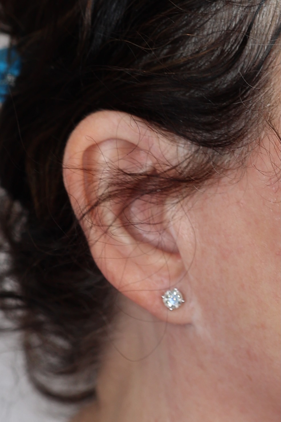 Earlobe Reduction