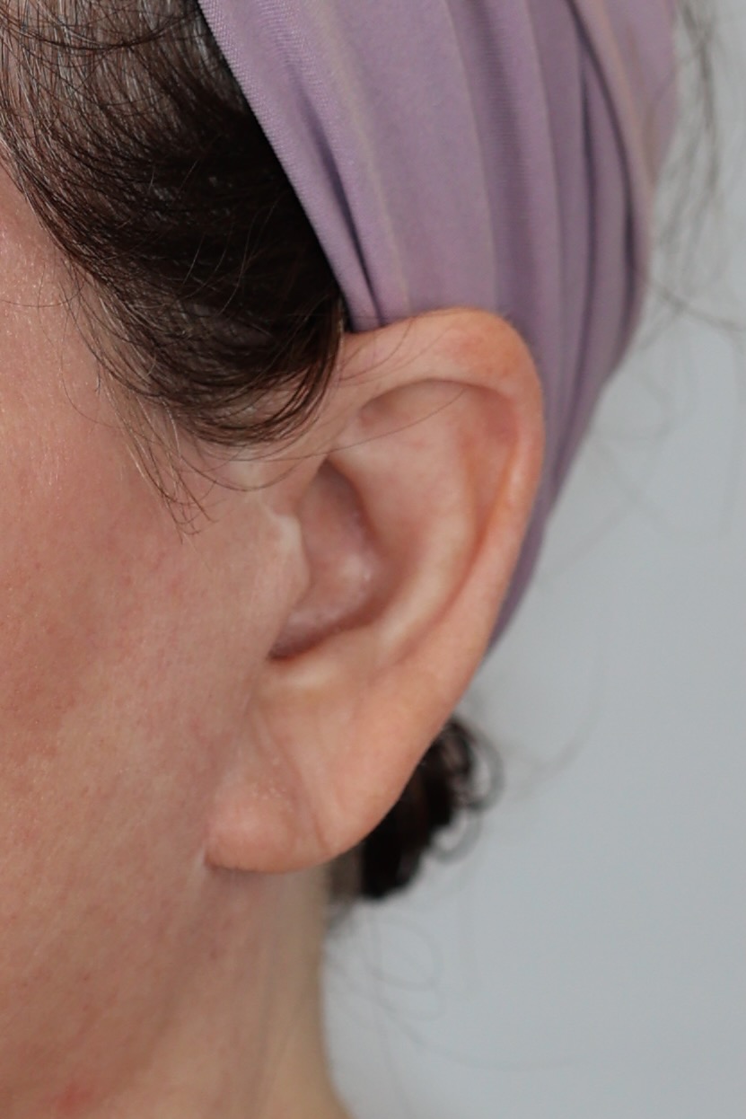 Earlobe Reduction