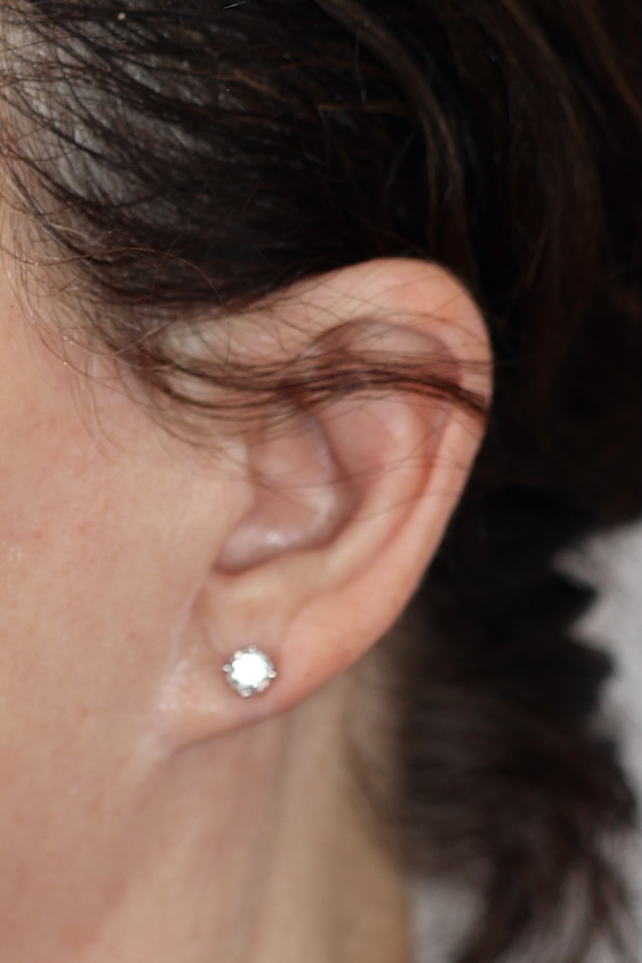 Earlobe Reduction