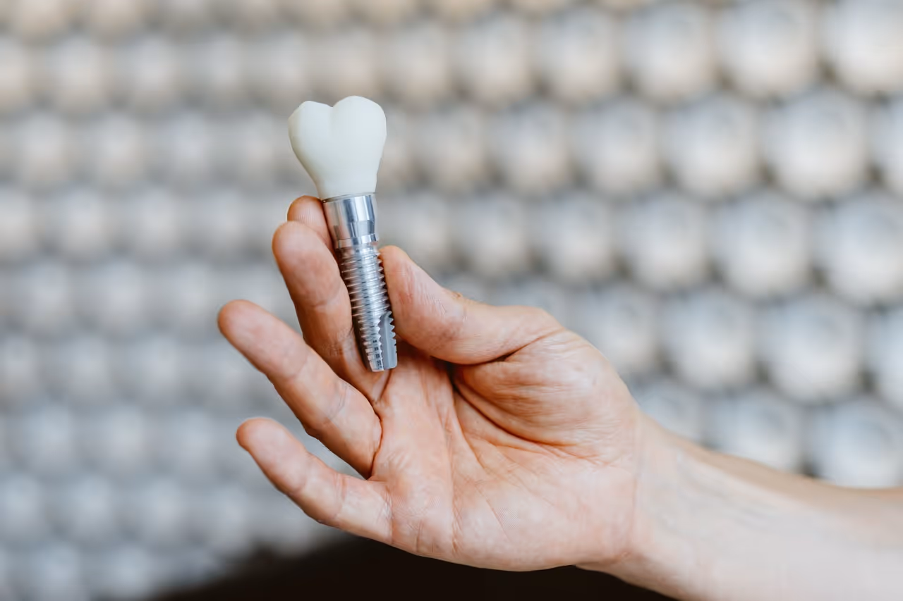 Implantes dentales tras una extracción: ¿es posible?