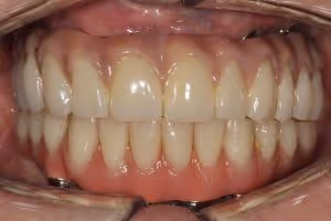 full mouth missing teeth after