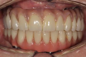 full mouth missing teeth after