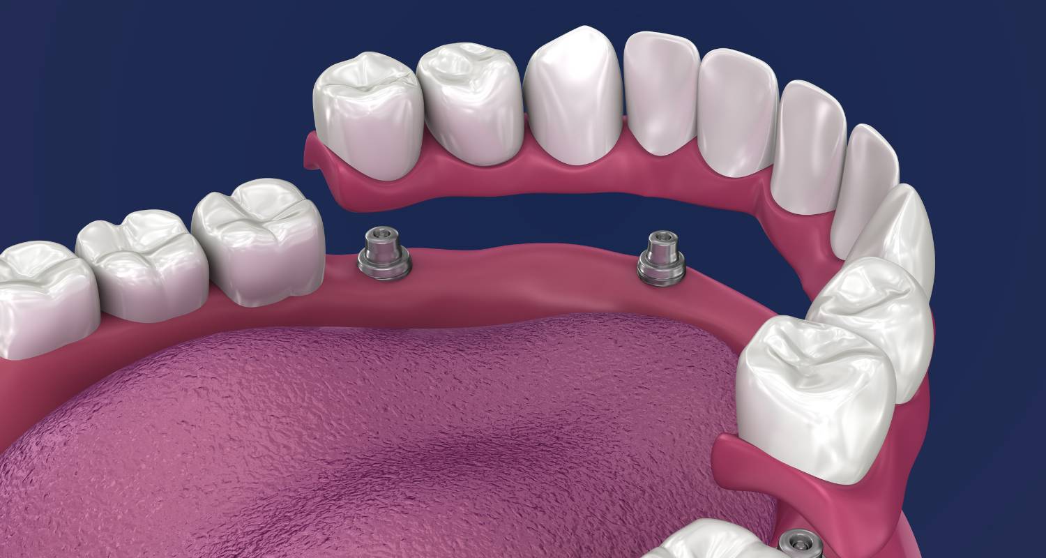 all on 4 dental implants image