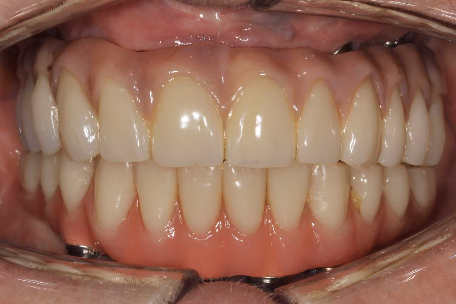 full mouth missing teeth after