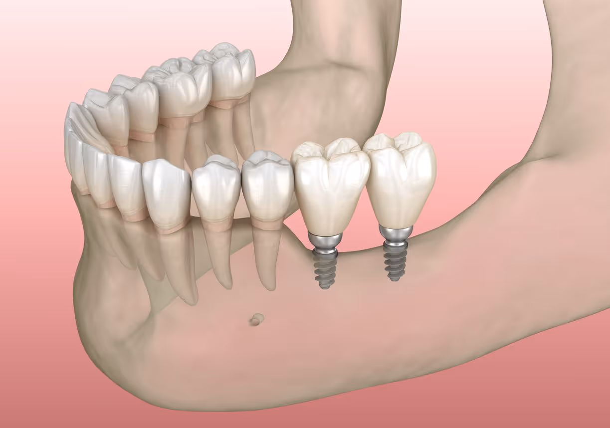 mini dental implants