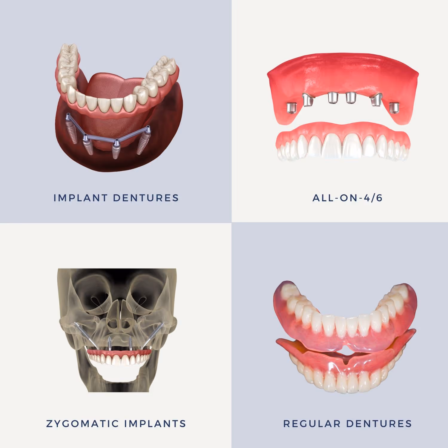 full mouth missing teeth options