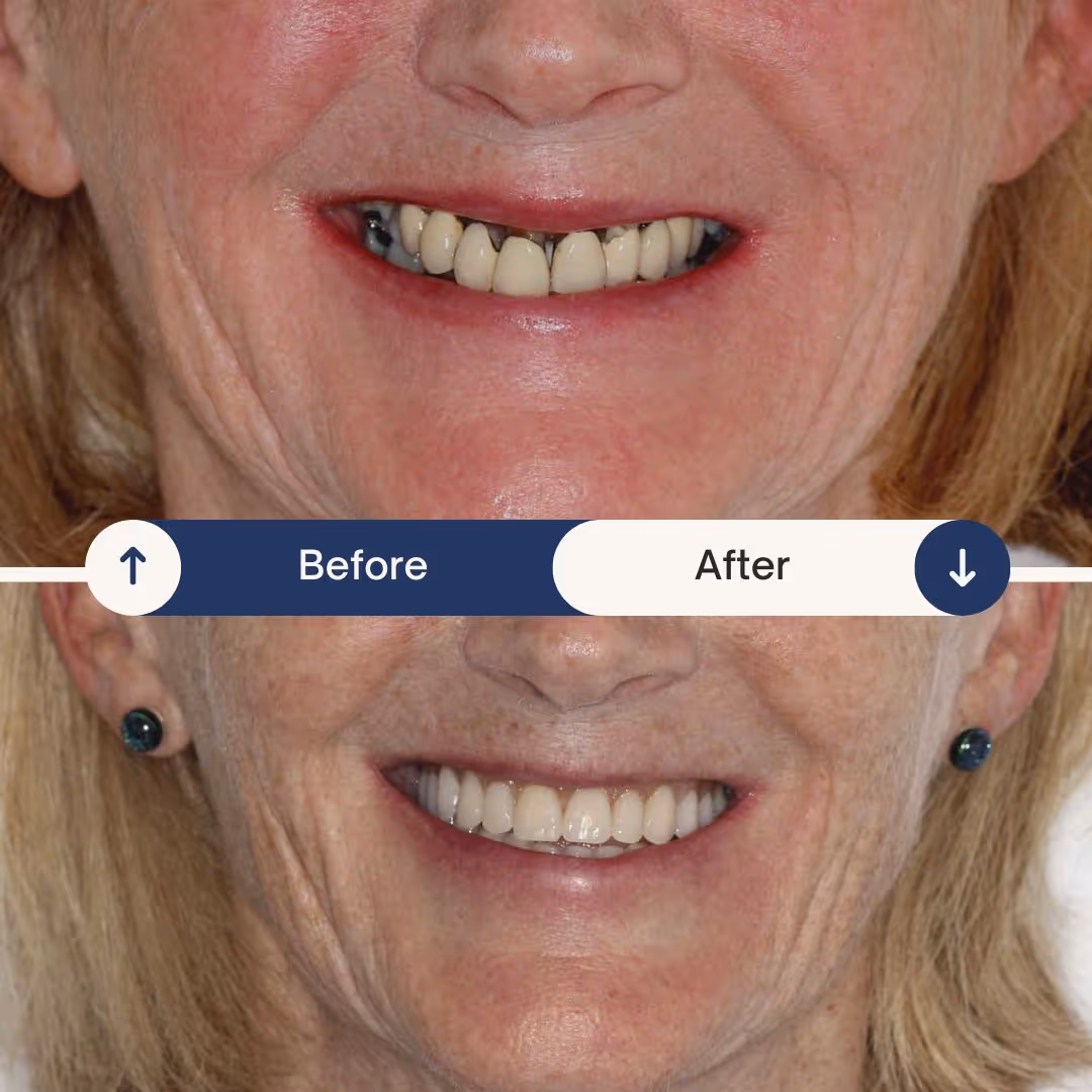 dental implant before and after