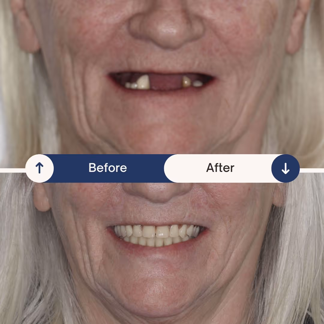 dental implant before and after