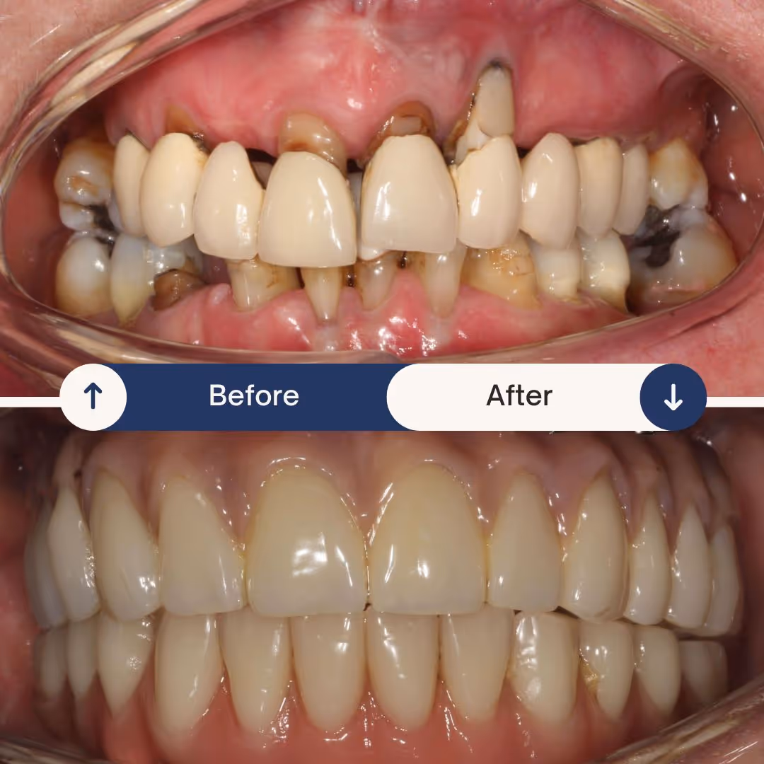 dental implant before and after