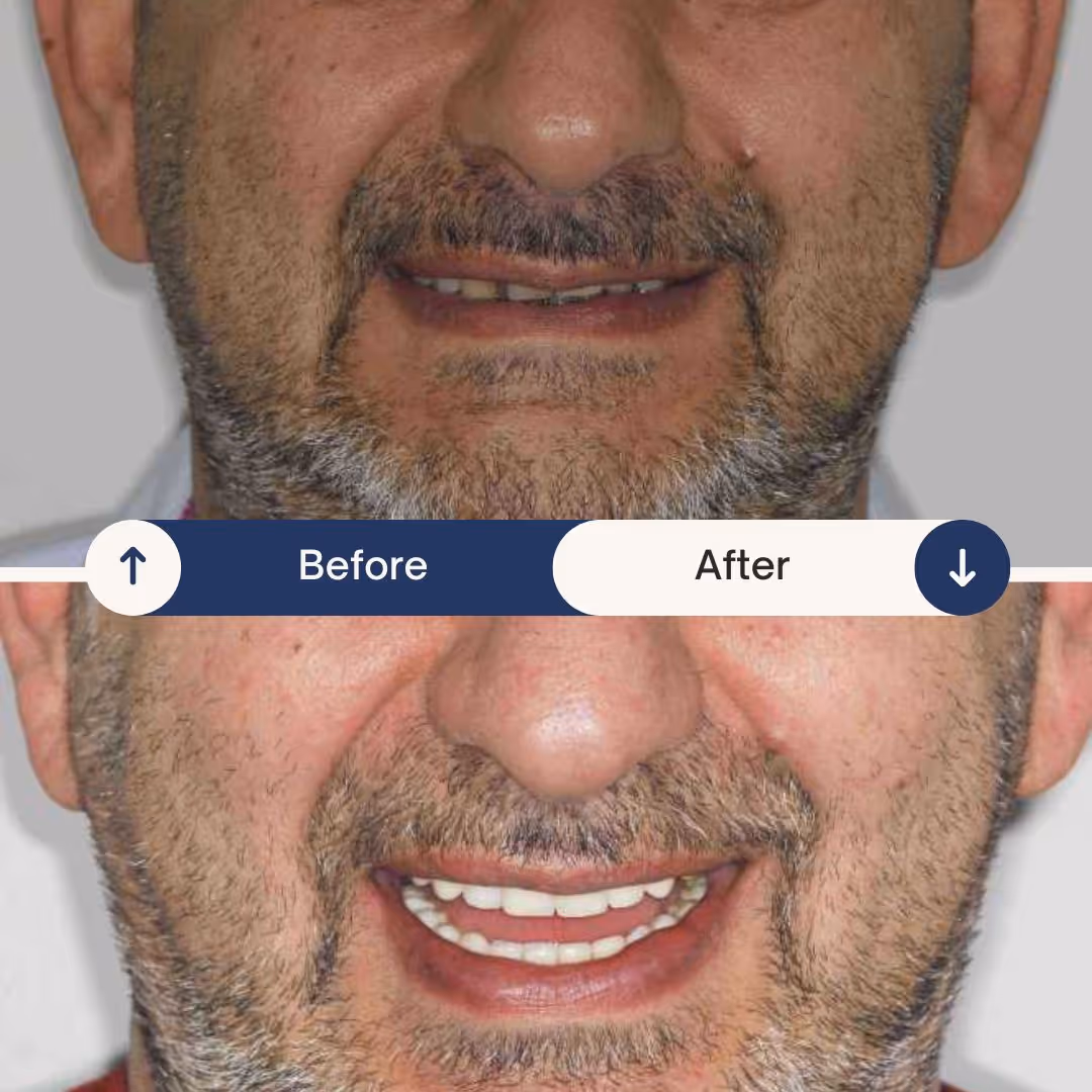 dental implant before and after