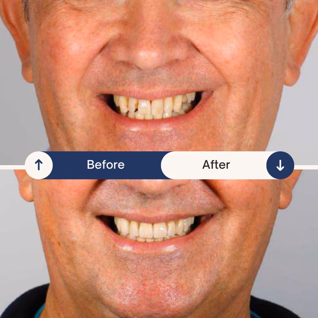 dental implant before and after