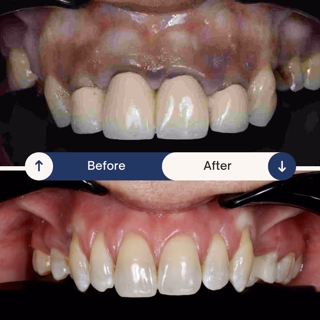 dental implant before and after