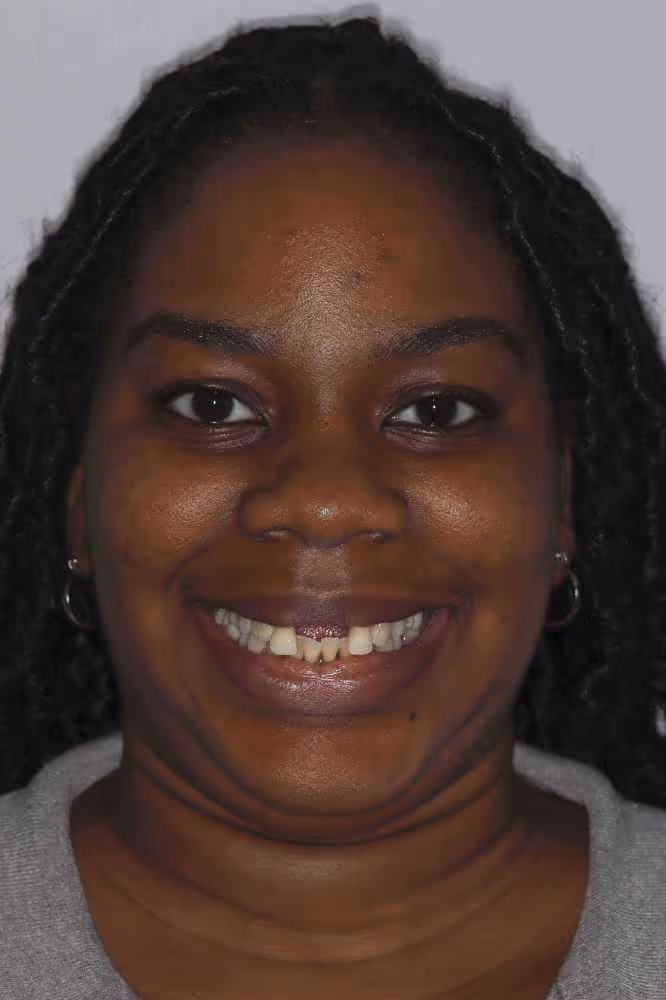 missing front two teeth case