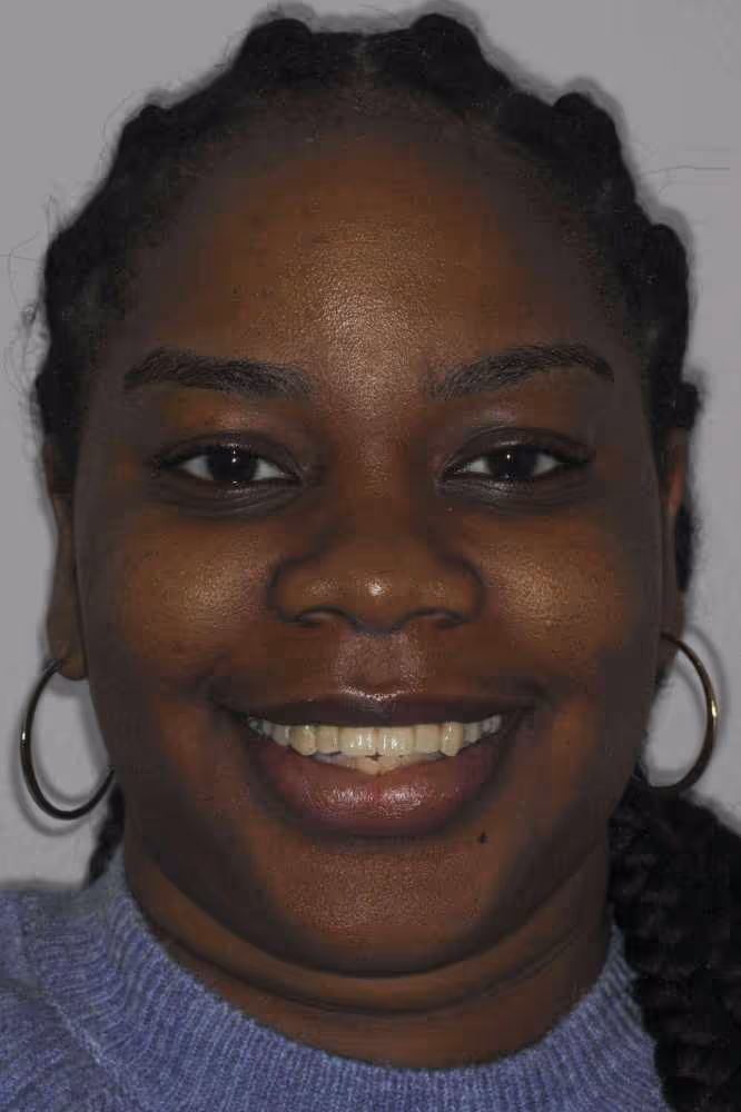 front two missing teeth replaced