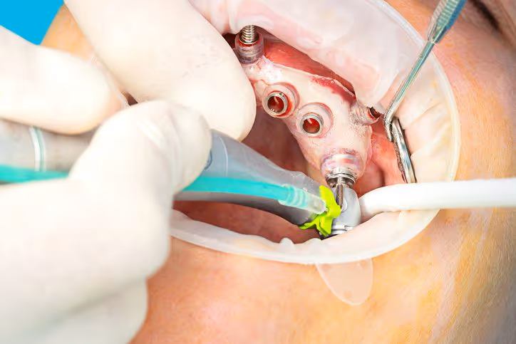 dental implant procedure photo