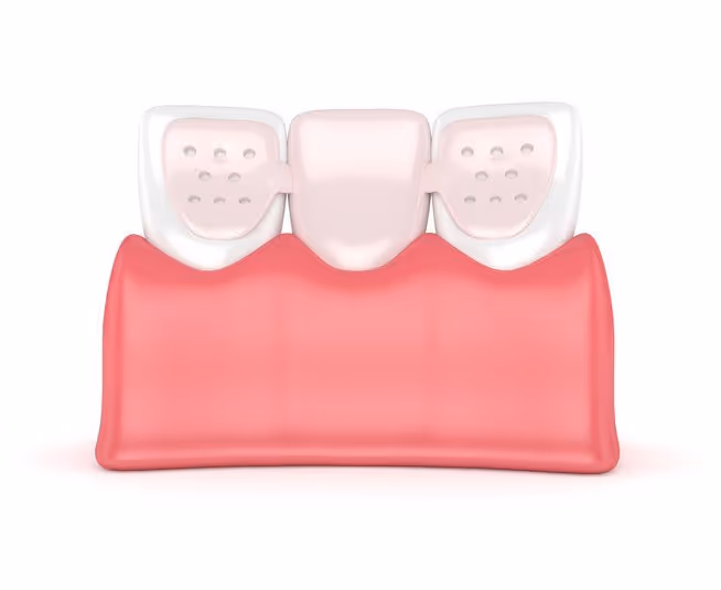 maryland dental bridge image