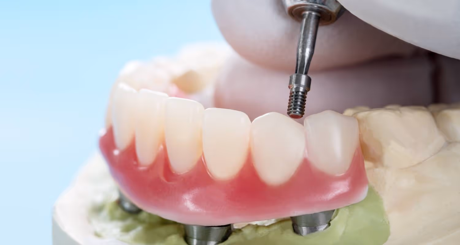 implant-supported dentures image