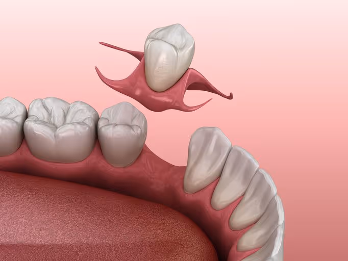 front tooth denture image