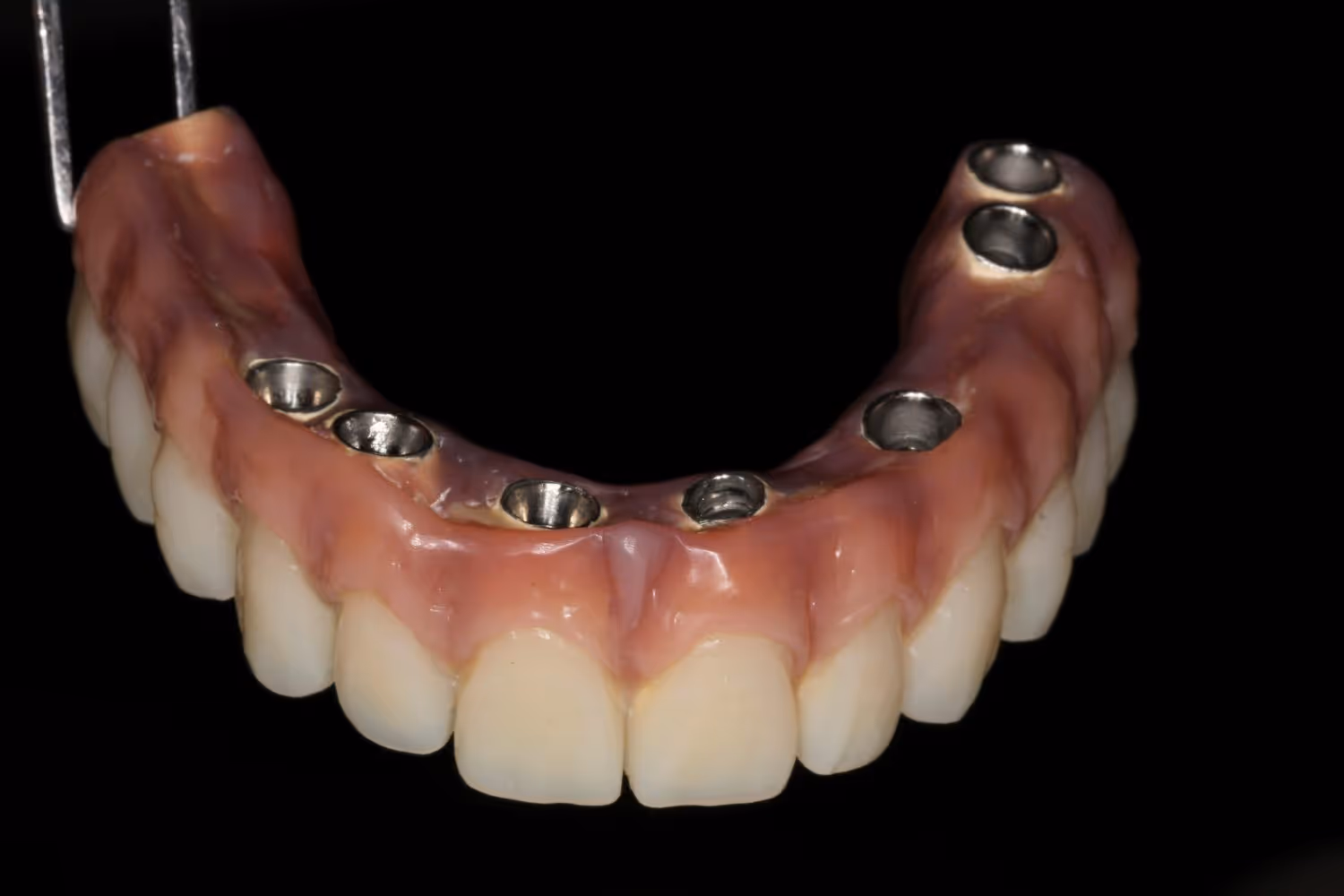 all on 4 dental implants image