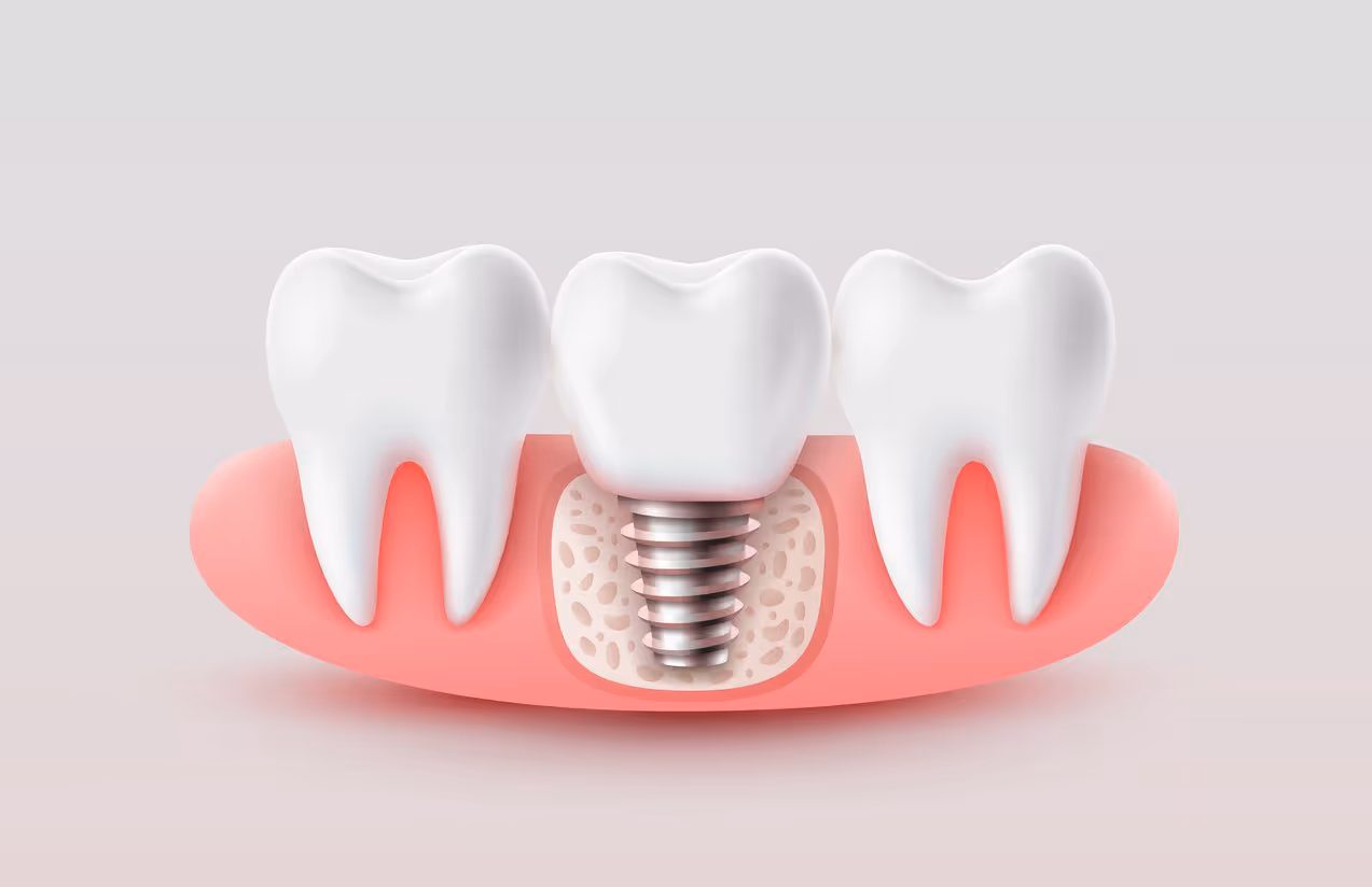 render of dental implant