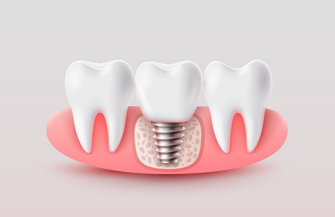 render of dental implant