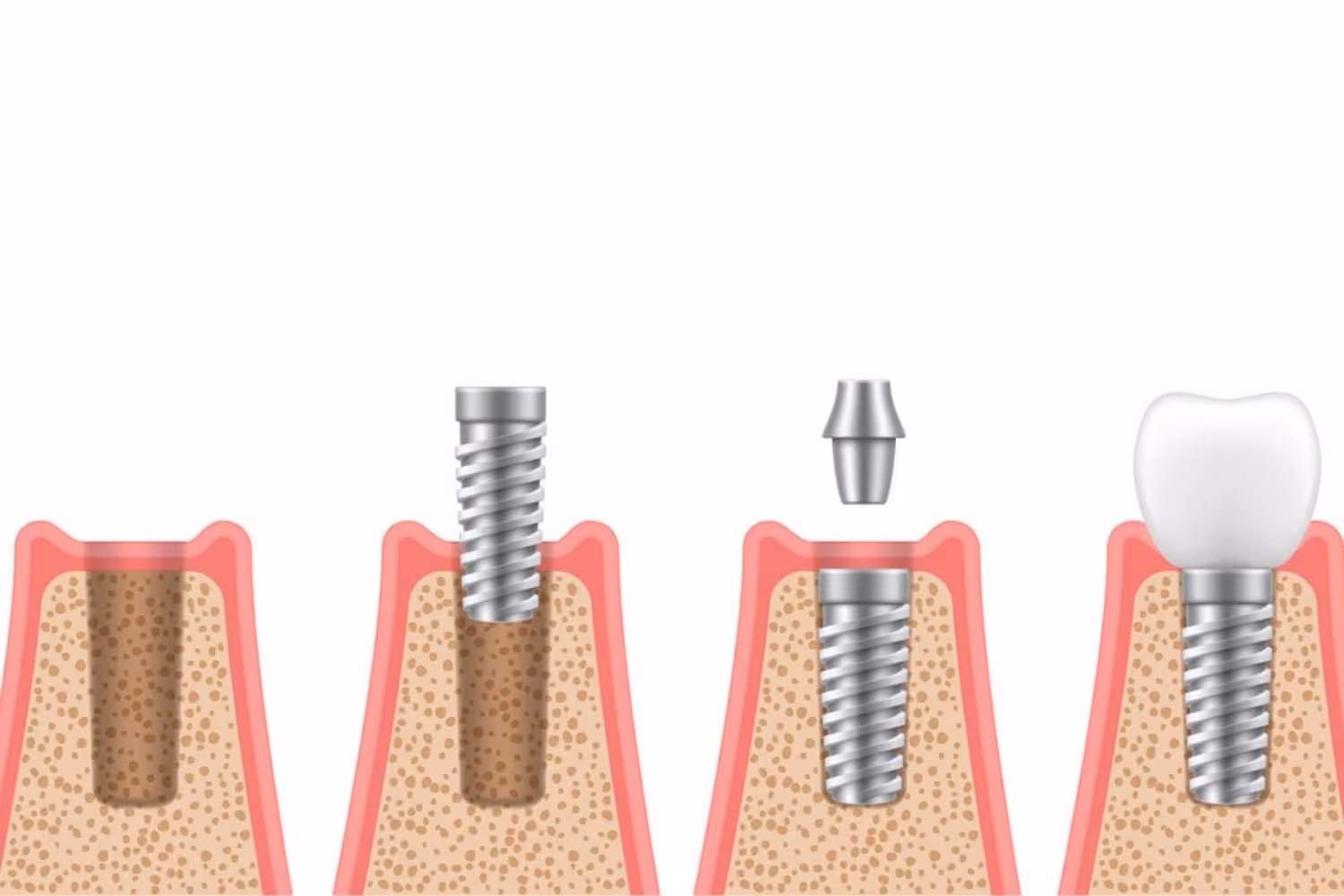 dental implant stages images