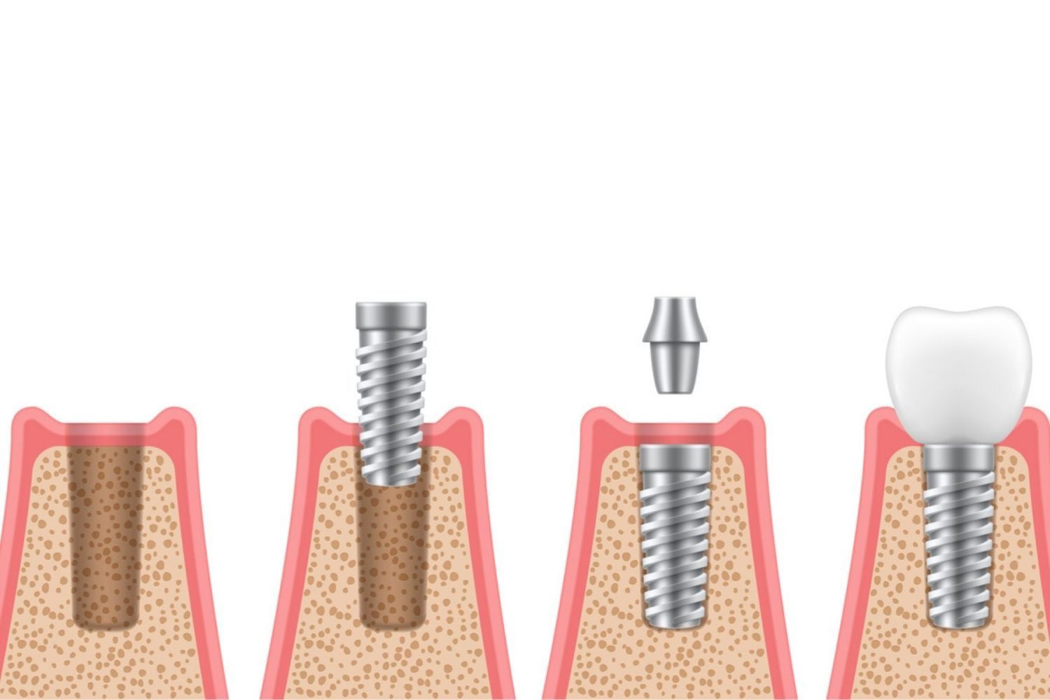 dental implant stages images