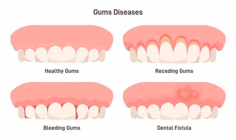 receding gums explanation