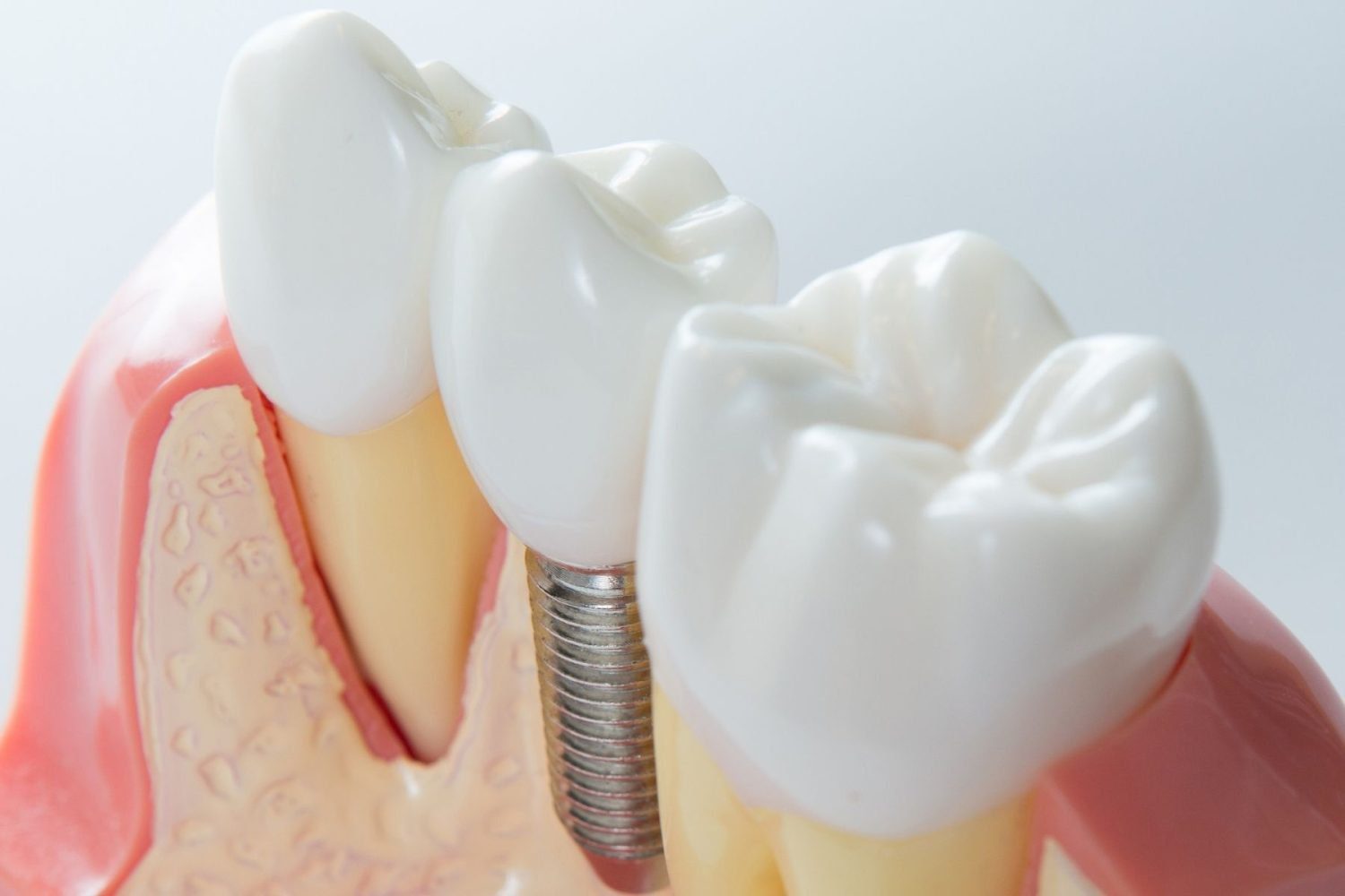 dental implant procedure