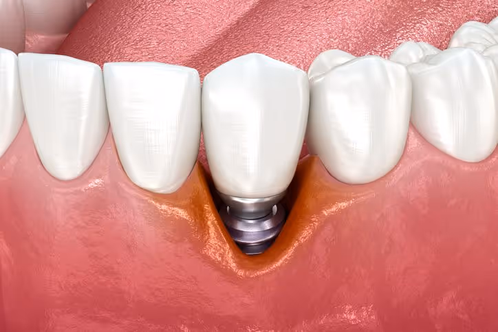 Diagnosing and Treating Peri-implantitis