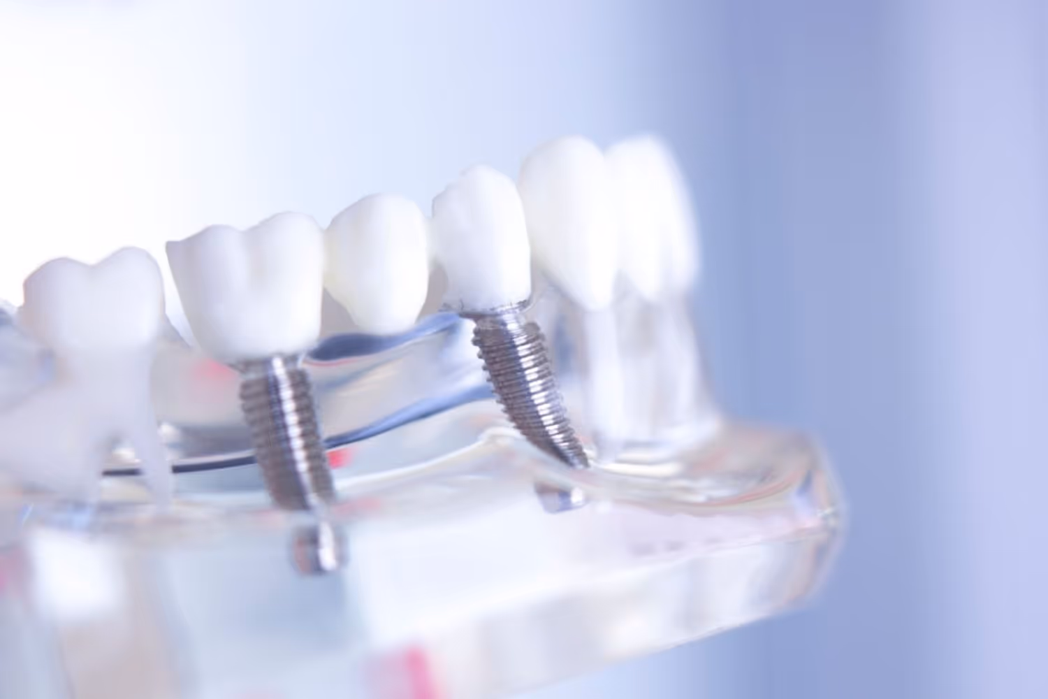 dental implant photo