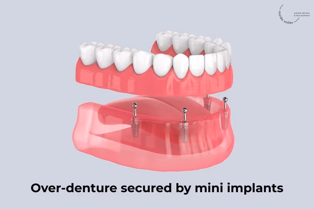 over denture