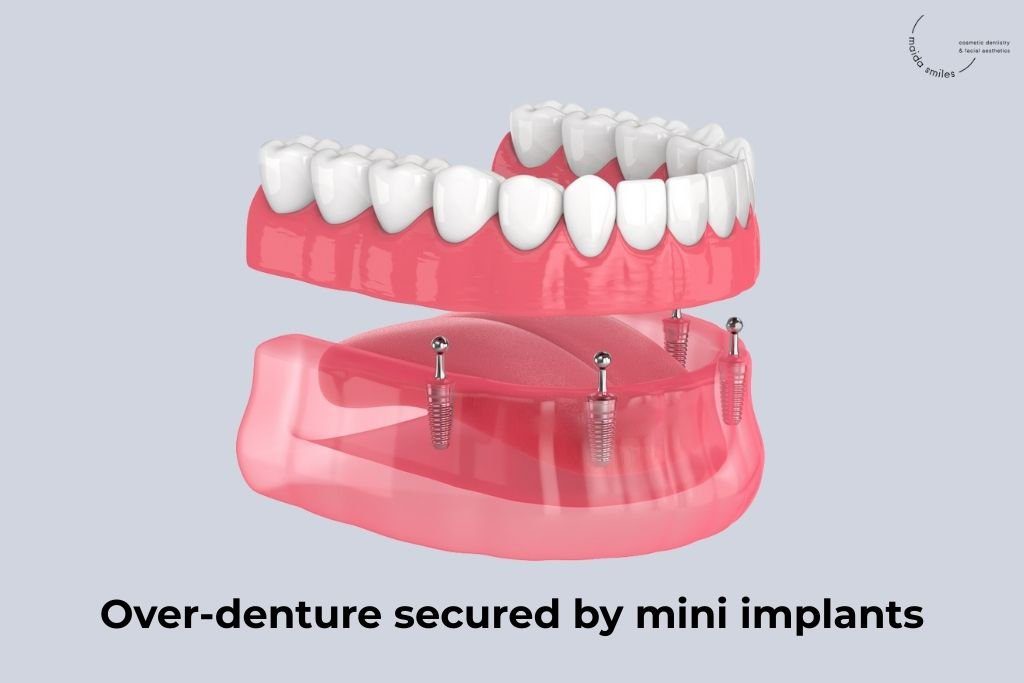 over denture