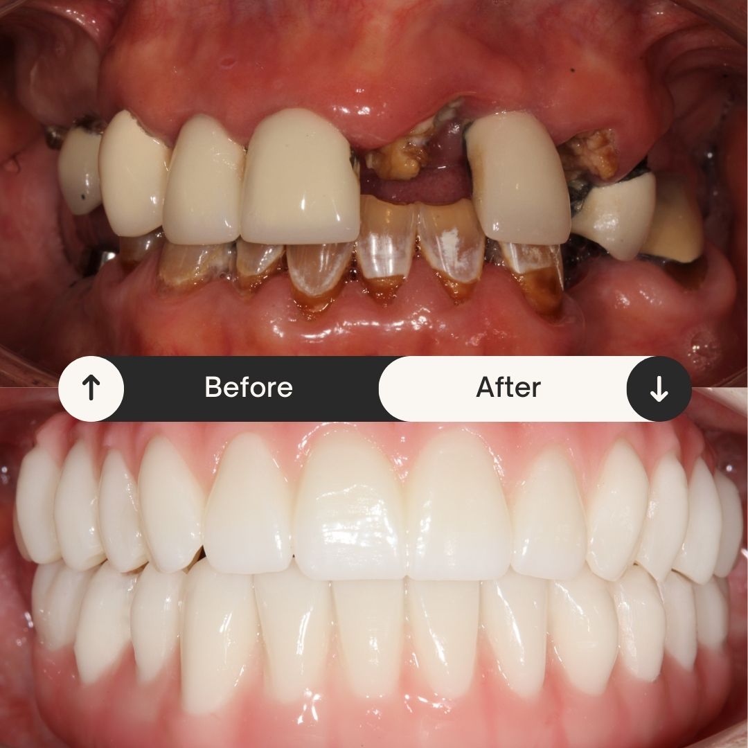 complete full mouth restoration