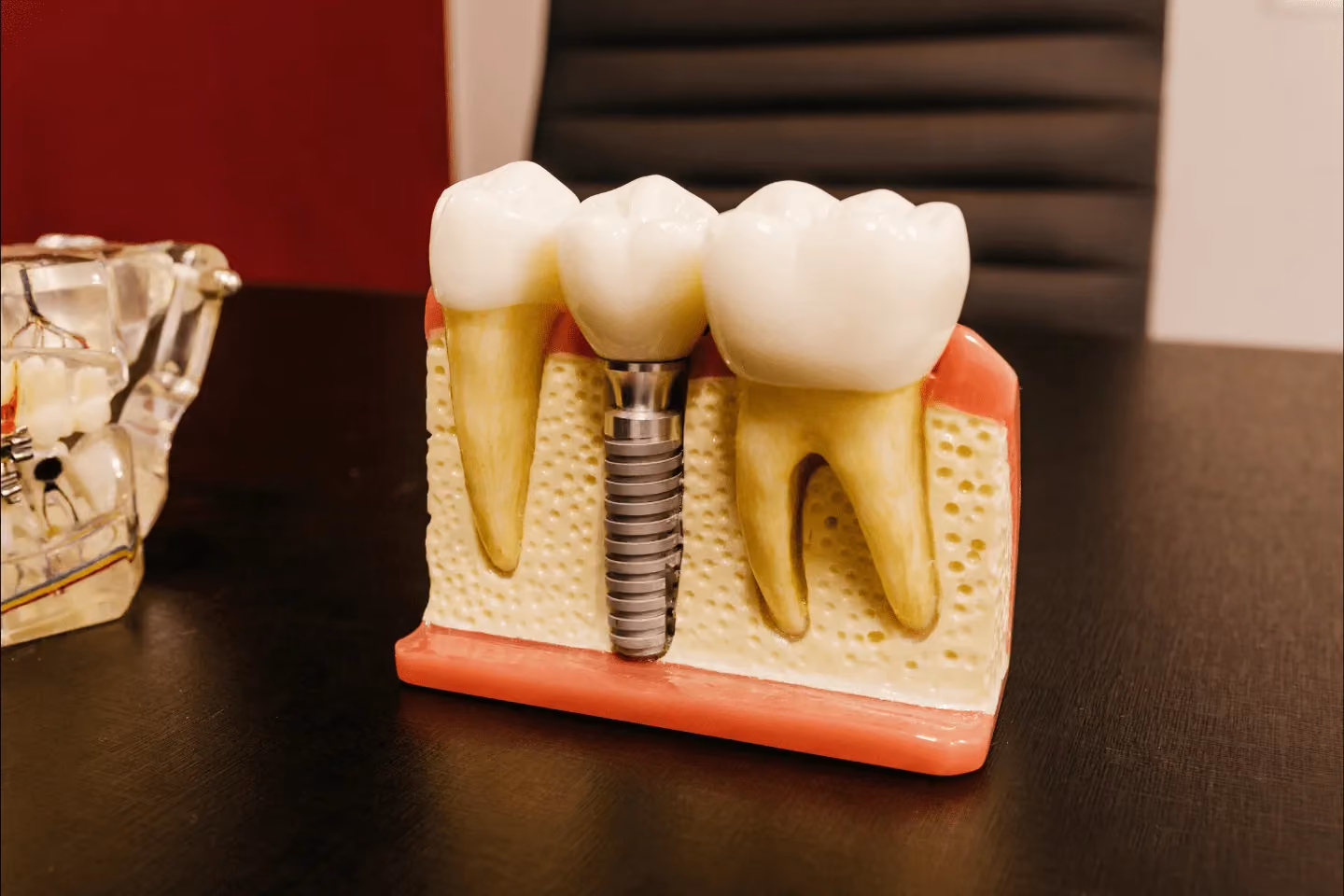 Tratamentos dentários na Turquia que correram mal – valerá a pena optar por implantes baratos?