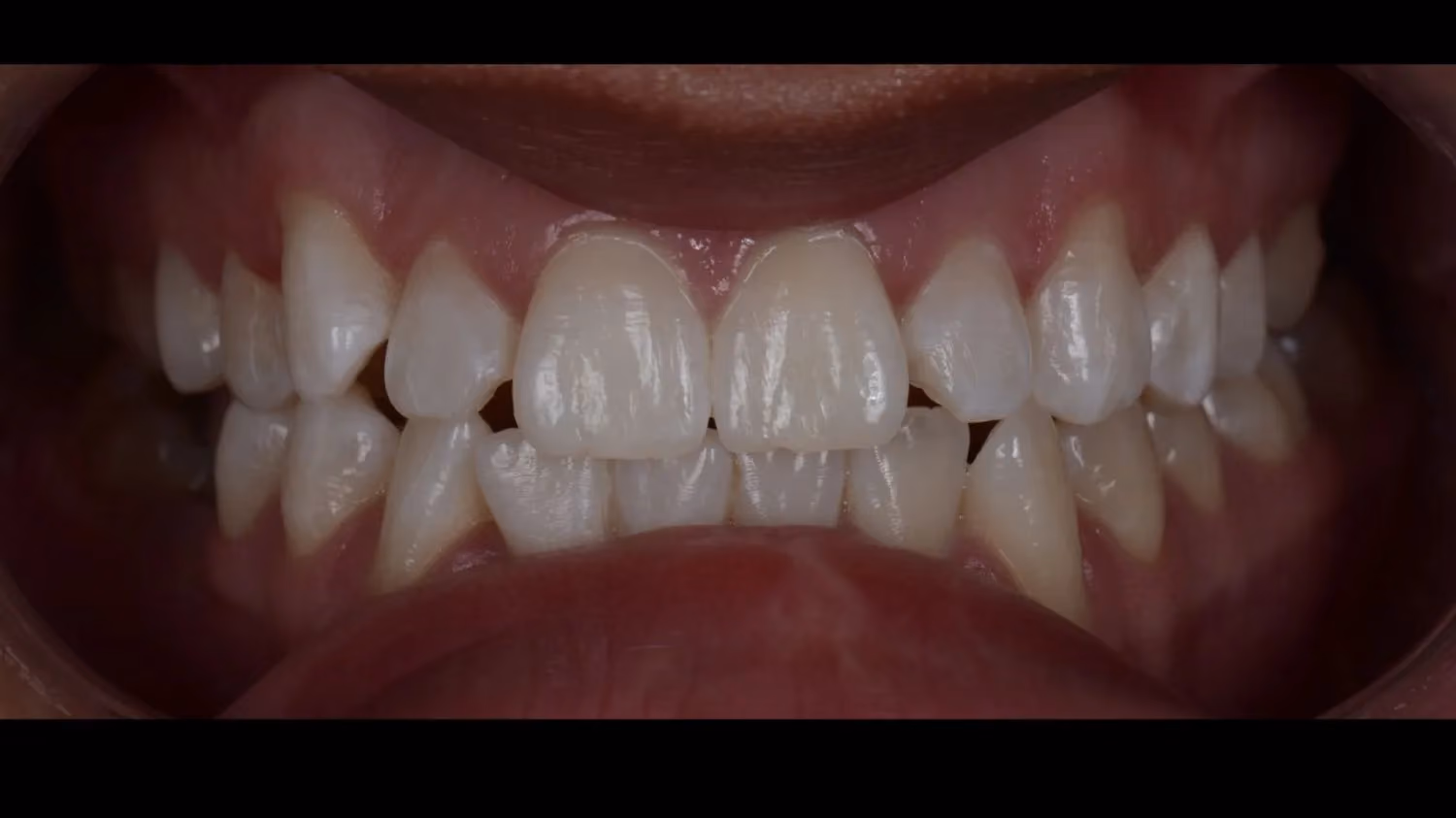 Patient smile after teeth whitening at Maida Smiles, Maida Vale
