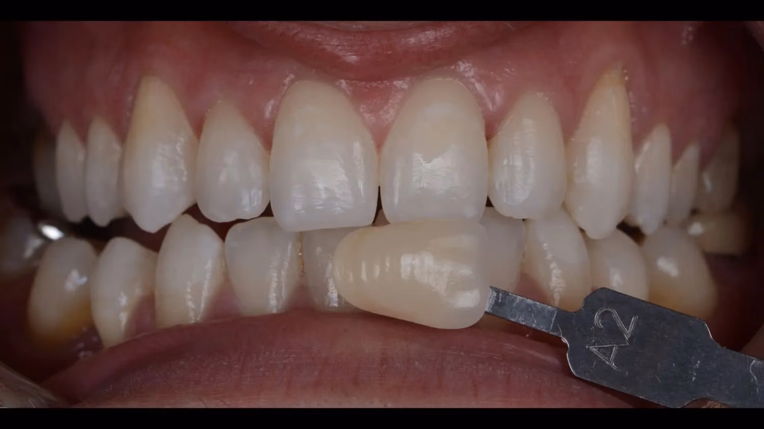Patient smile after teeth whitening at Maida Smiles, Maida Vale