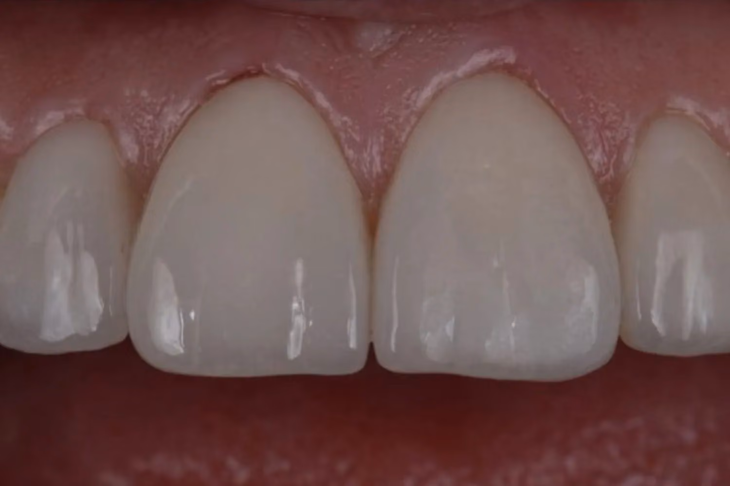 Patient smile after dental veneers at Maida Smiles, Maida Vale