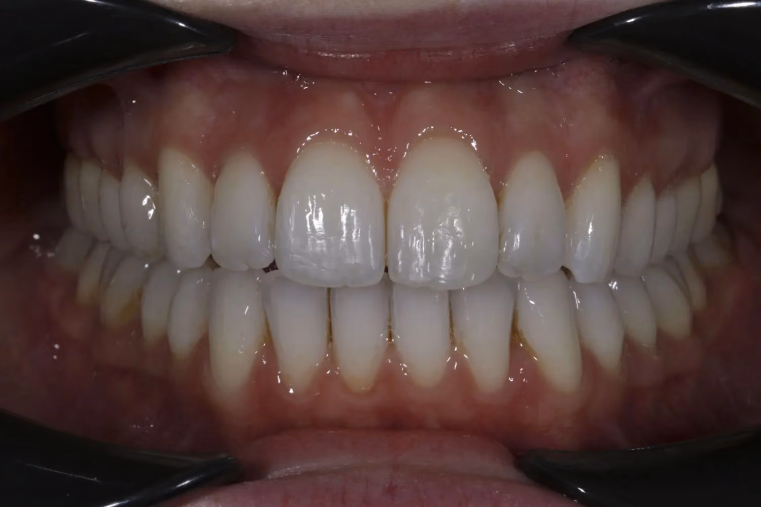 Patient smile after Invisalign teeth straightening at Maida Smiles