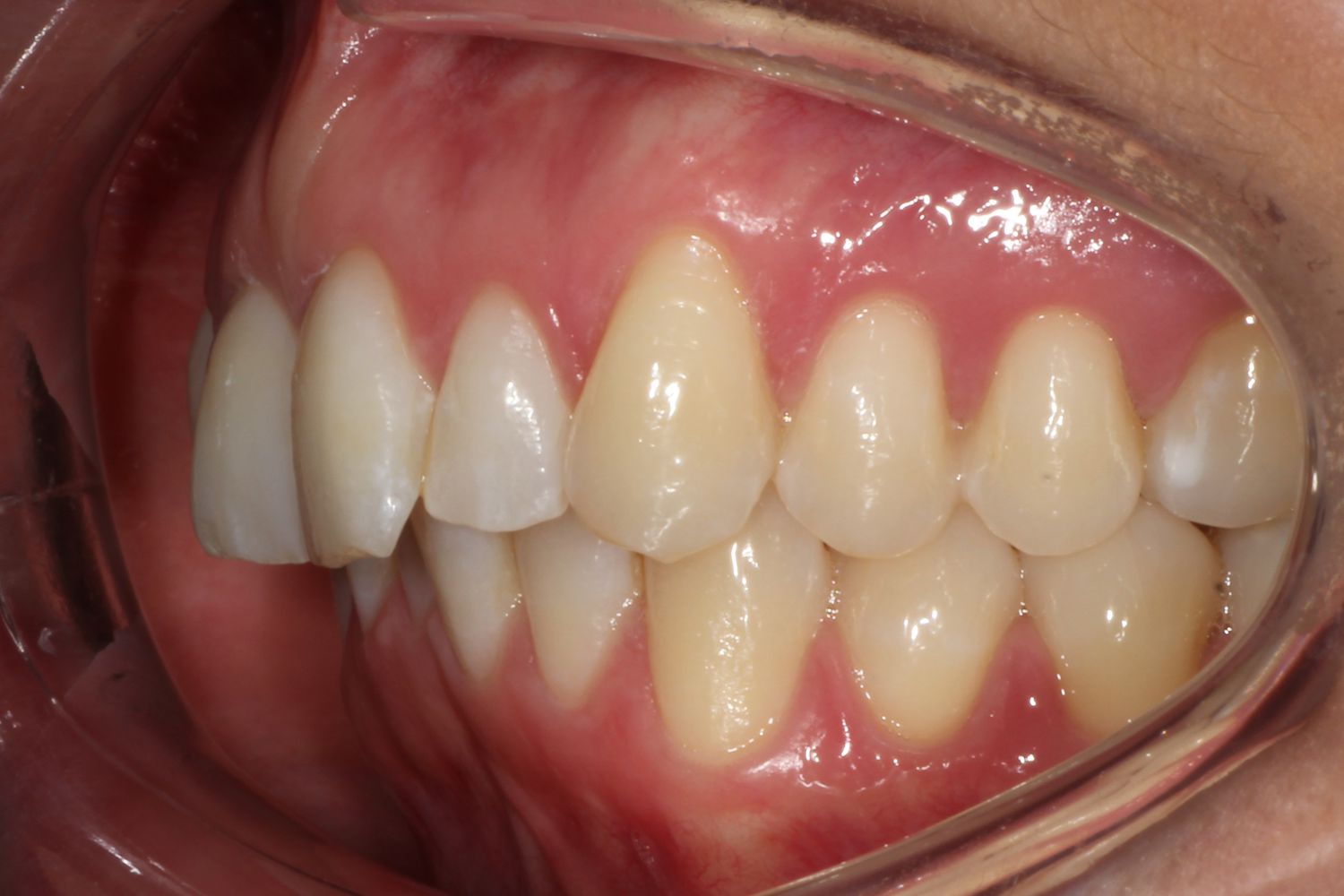 Protruding teeth before treatment at Maida Smiles