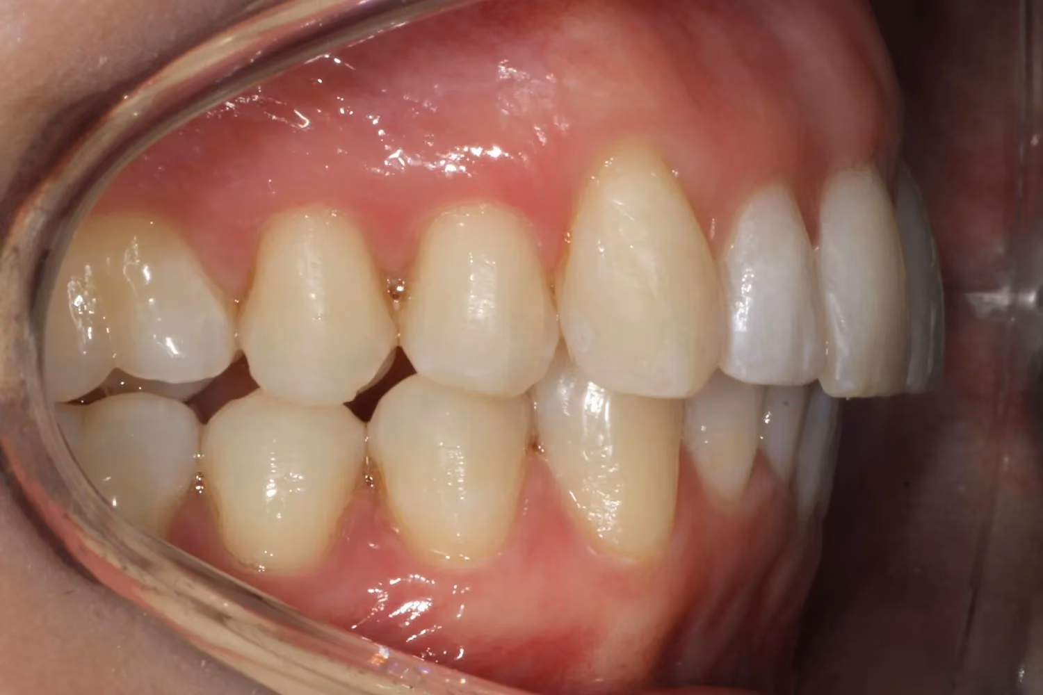 Patient smile after Invisalign teeth straightening at Maida Smiles