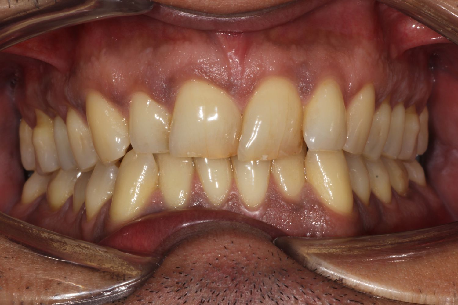 Crooked, discoloured teeth before treatment at Maida Smiles