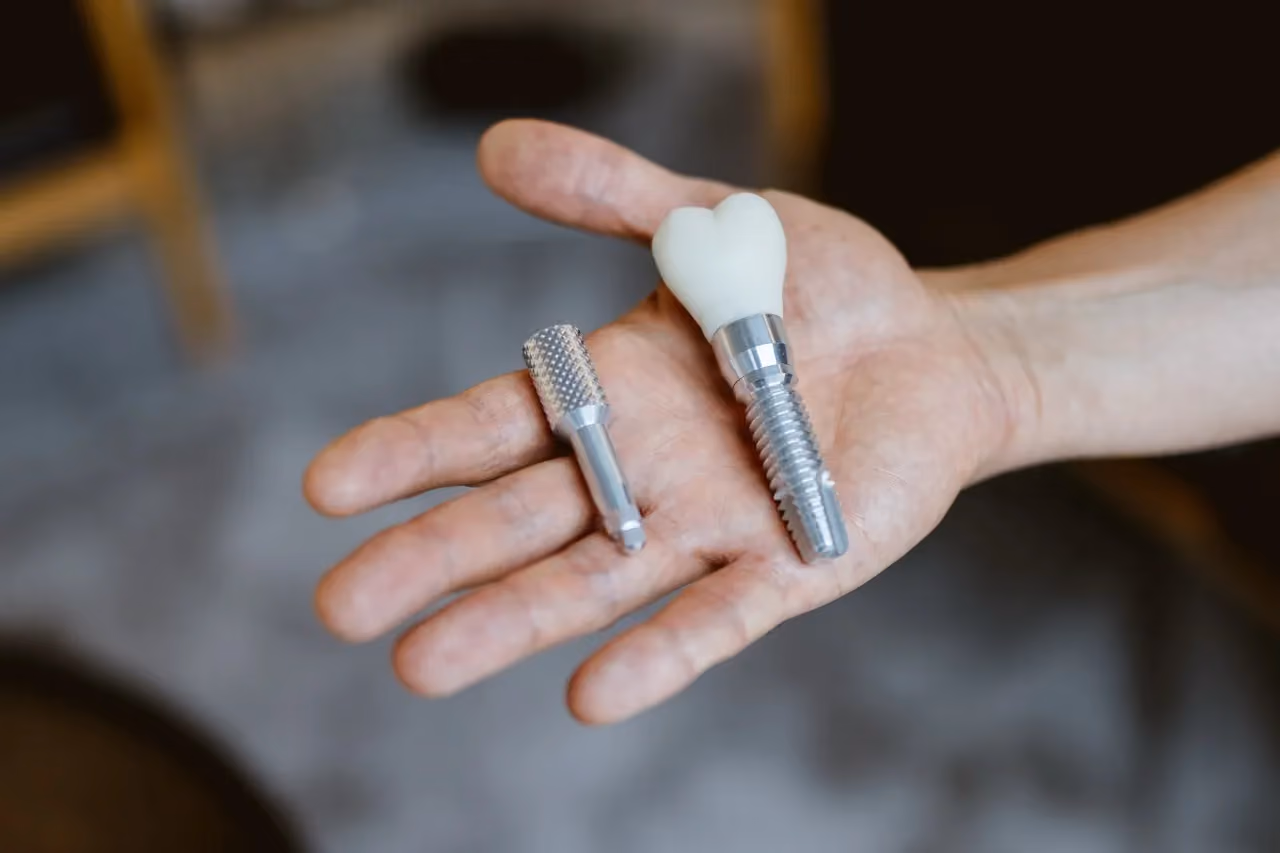 Peri-implantitis treatment at Maida Smiles, Maida Vale
