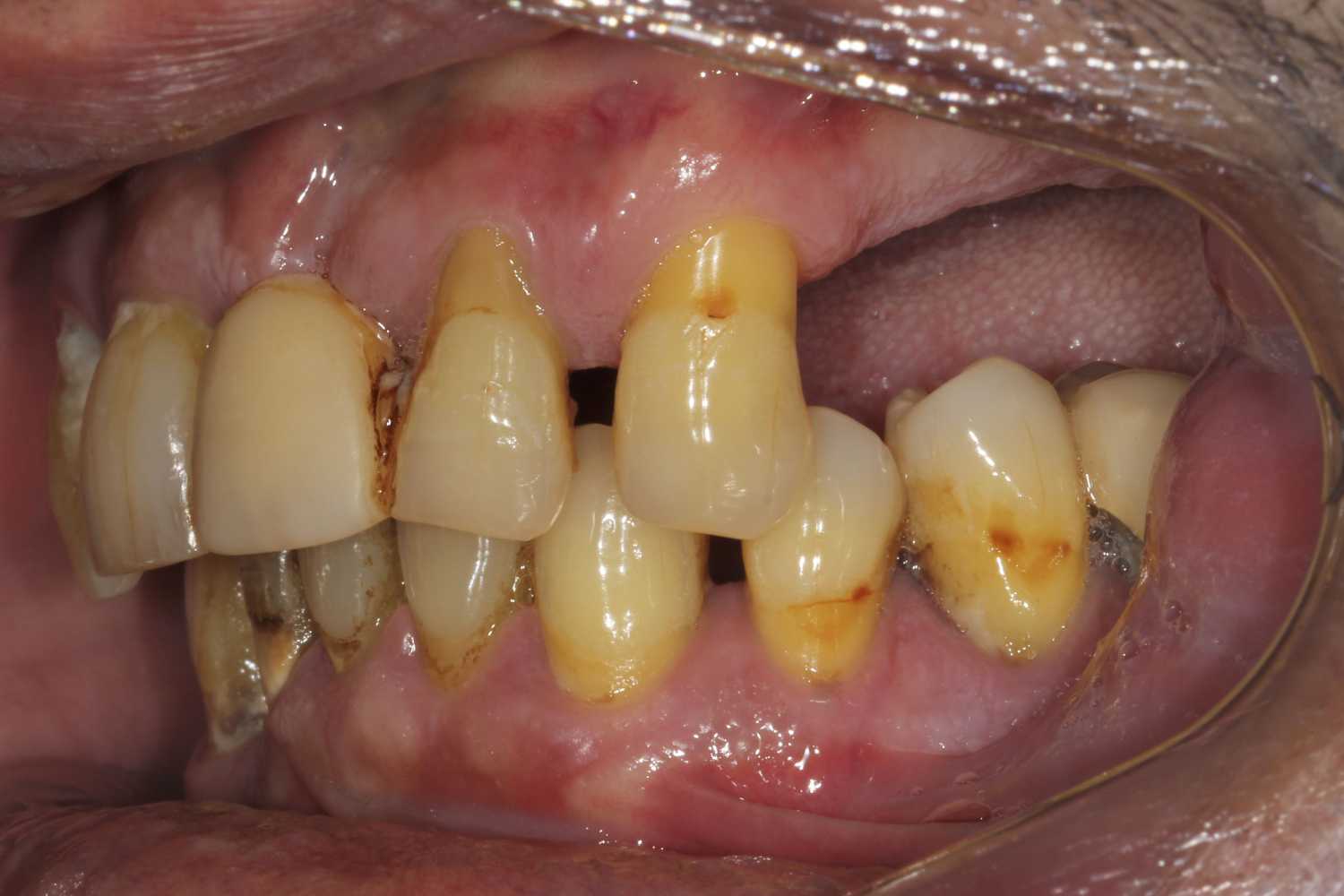 missing teeth before all on 4